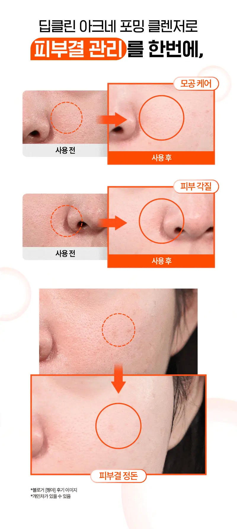 [매끈클린모공폼/트러블예방] 뉴트로지나 아크네 포밍 클렌저 100g 상세페이지 9
